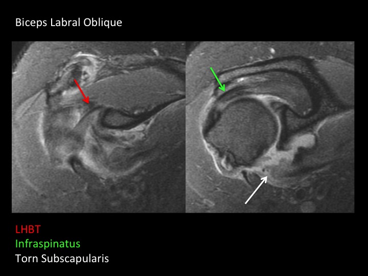Figure 3 for case subscapularis tendon ( RID1951 )